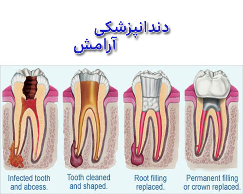 گسترش-عفونت-پالپ-دندان