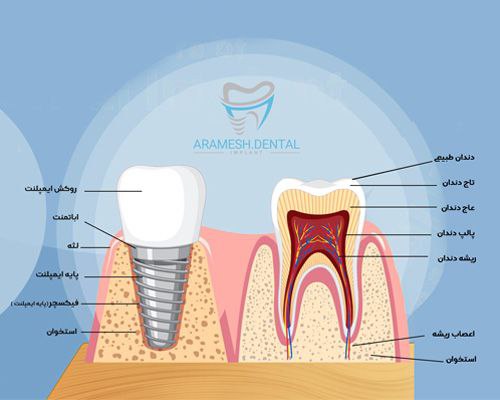 ایمپلنت دندان یک جایگزینی مادام العمر برای دندان های از دست رفته شما است.
