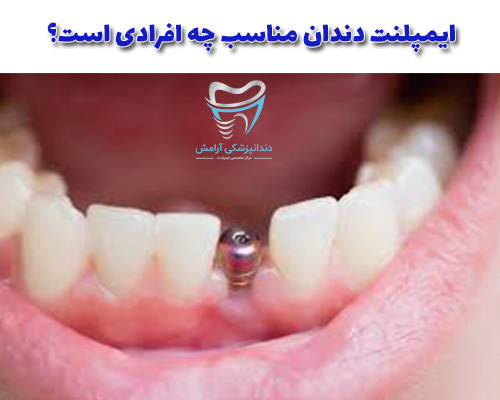 تقریبا ایمپلنت دندان برای همه افراد مناسب است، فقط بین 5 تا درصد ایمپلنت دندان ناموفق می‌شود.