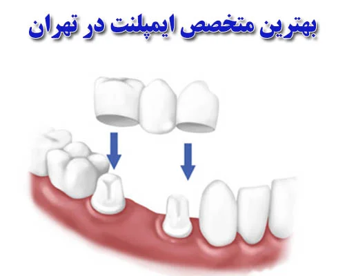 بهترین متخصص ایمپلنت در تهران