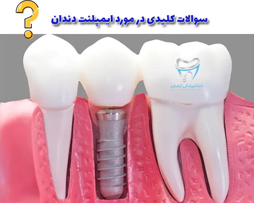 اگر شاغل هستید برای انجام جراحی و کاشت ایمپلنت دندان حتما 1 یا 2 روز مرخصی بگیرید.