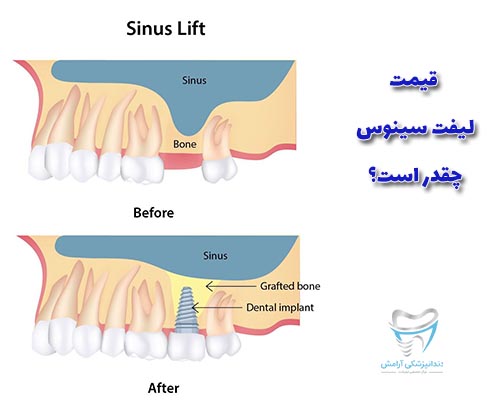 جراحی لیفت سینوس یکی از موارد تاثیر گذار رو قیمت ایمپلنت دندان می‌باشد.