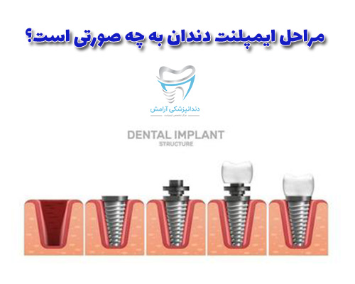 در مرحله اول برای ایمپلنت دندان باید بهترین متخصص ایمپلنت دندان را پیدا کنید.