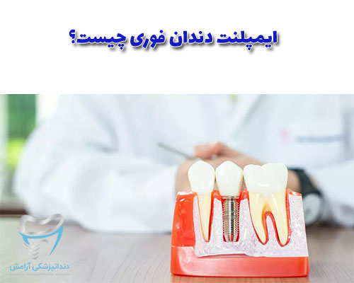 ایمپلنت فوری بهترین روش برای از دندان های از دست رفته شما است که از لحاظ روانی حس بهترین به شما می‌دهد.