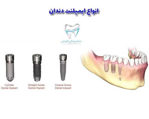 تفاوت انواع ایمپلنت ها میتوان در نحوه قرار گیری فیکسچر در استخوان فک باشد.