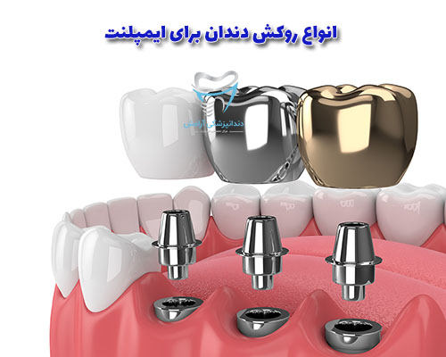 روکش ایمپلنت دندان، مانند دندان مصنوعی میتواند جنس های متفاوتی داشته باشد.