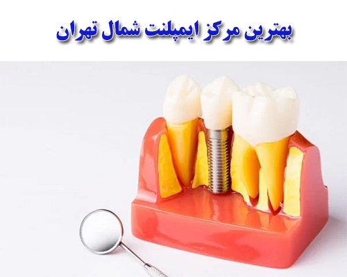 ایمپلنت دندان شمال تهران 