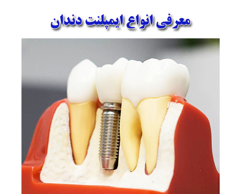 معرفی انواع ایمپلنت دندان
