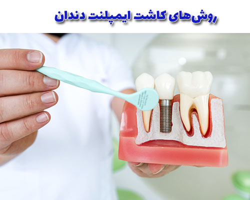 روش‌های کاشت ایمپلنت دندان