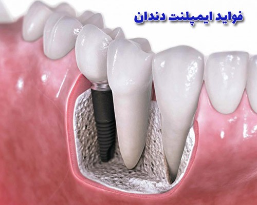 فواید ایمپلنت دندان