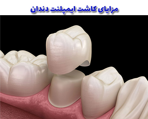 مزایای کاشت ایمپلنت دندان