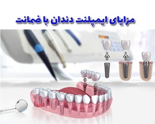 مزایای ایمپلنت دندان با ضمانت این است که مشخص میکند مرکز ایمپلنت آرامش به فکر سلامت و هزینه مشتریان خود است.