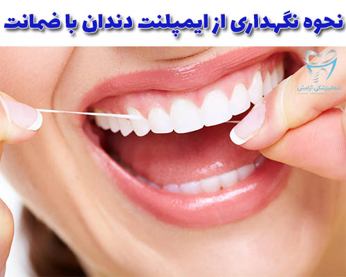 نحوه نگهداری از ایمپلنت دندان با ضمانت دقیقا باید شبیهه دندان های طبیعی خودتان باشد.