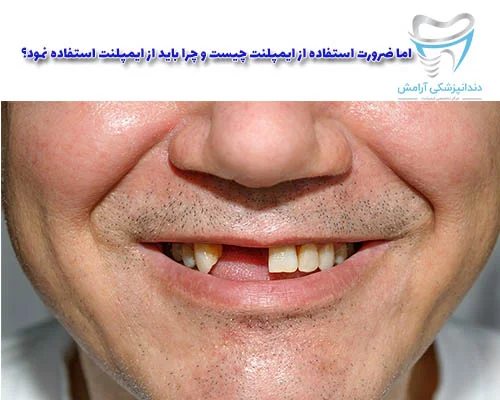 اگر دندانتون را کشیدید جای آن را خالی نزارید چون رو چهره شما به مرور تاثیر میگذارد