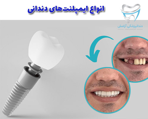 ایمپلنت های دندان از طریق کشورهای سازندشون با هم فرق می کند.