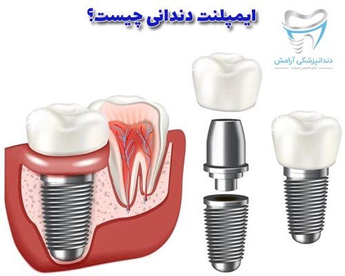 ایمپلنت دندان بهترین روش برای داشتن دندان های مرتب می باشد.