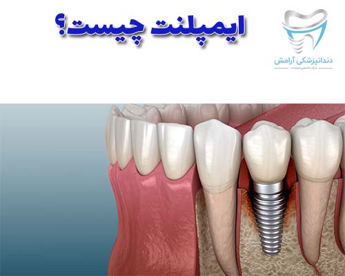 ایمپلنت دندان دارای دو جز است که یکی میله فلزی و رویه پروتز است