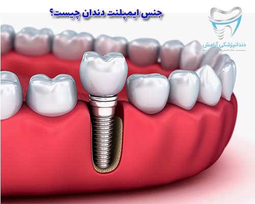 جنس اجزا ایمپلنت فلزی و پروتز دندان است
