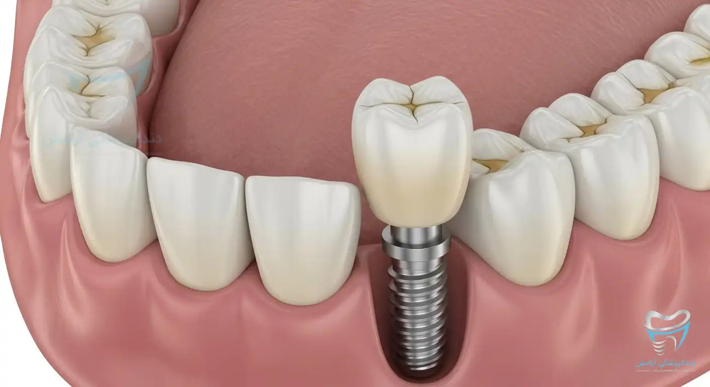 تصویری از ایمپلنت دندان نیش بالا