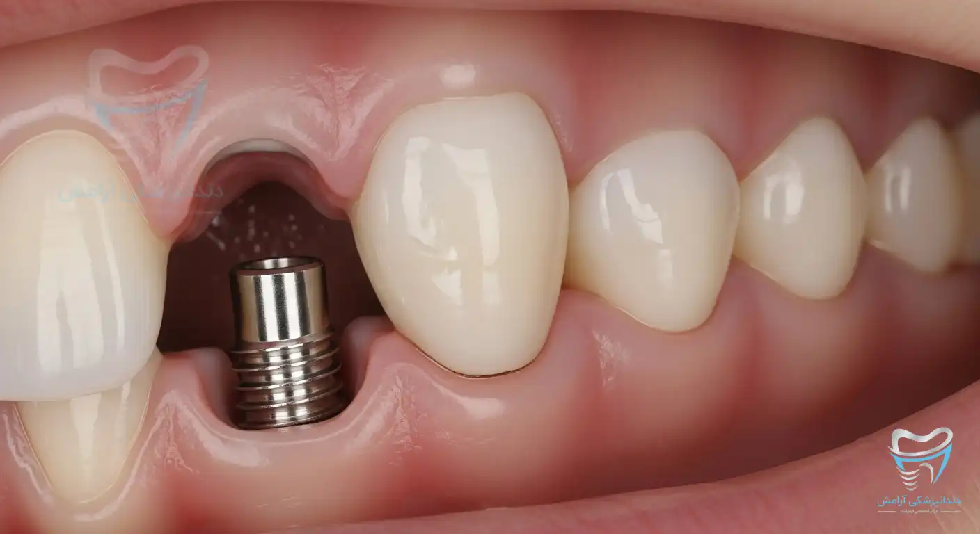 ایمپلنت دندان نیش