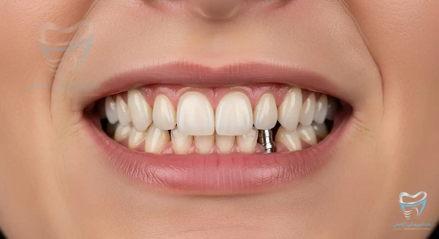 مدت زمان ایمپلنت دندانهای نیش