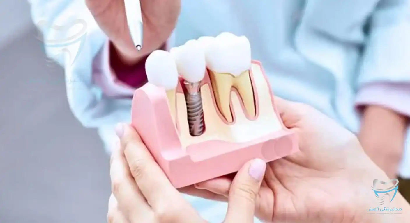 تصویر دندانی برای موضوع طول عمر ایمپلنت دندان