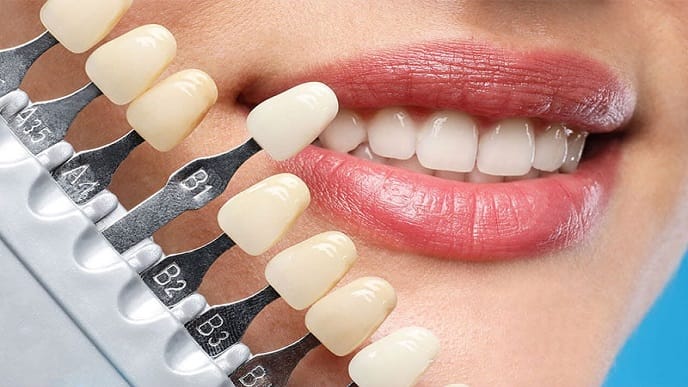 لمینت دندان چیست؟ لمینت دندان برای چه کسانی مناسب است؟