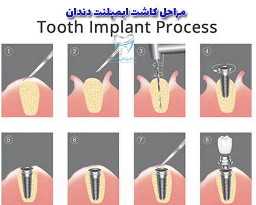 مراحل کاشت ایمپلنت دندان، معمولا در هفت کرحله انجام می‌شود.