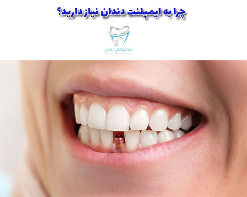 برای زمانی که شما بیش از یک دندان خود را از دست داده اید، ایمپلنت دندان بهترین جایگزین است.