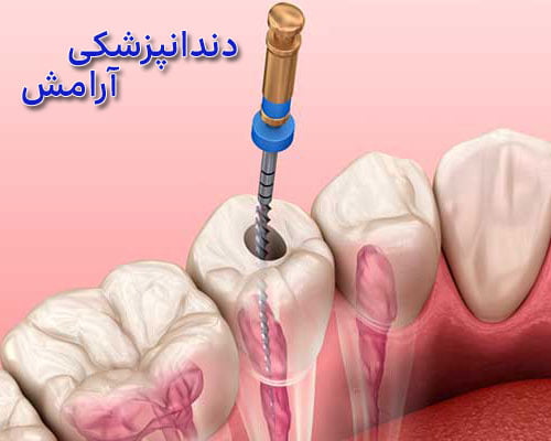 قیمت-عصب-کشی-دندان