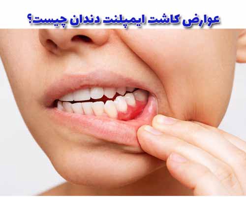 کاشت ایمپلنت دندان یک روش جراحی است و همانند سایر روش‌های جراحی، ممکن است برخی عوارض و مشکلات کوتاه‌مدت یا بلندمدت به همراه داشته باشد.
