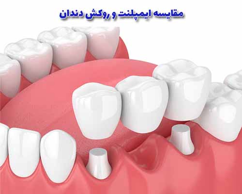 2 / 2 ایمپلنت دندان و روکش دندان (کراون) دو روش مختلف برای جایگزینی دندان‌های طبیعی از دست رفته یا آسیب دیده هستند.