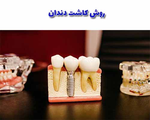 کاشت دندان یک فرآیند تخصصی است که توسط دندانپزشک مجرب و متخصص انجام می‌شود.