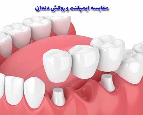 2 / 2
ایمپلنت دندان و روکش دندان (کراون) دو روش مختلف برای جایگزینی دندان‌های طبیعی از دست رفته یا آسیب دیده هستند.