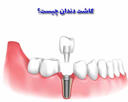 کاشت دندان یک روش جراحی است که در آن یک دندان مصنوعی یا ایمپلنت دندانی به استخوان فک ثابت می‌شود.