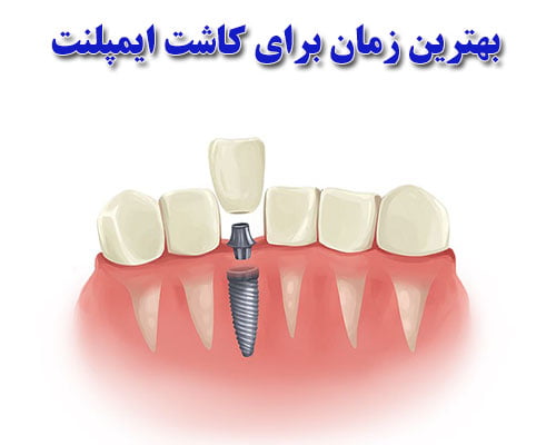بهترین زمان برای کاشت ایمپلنت