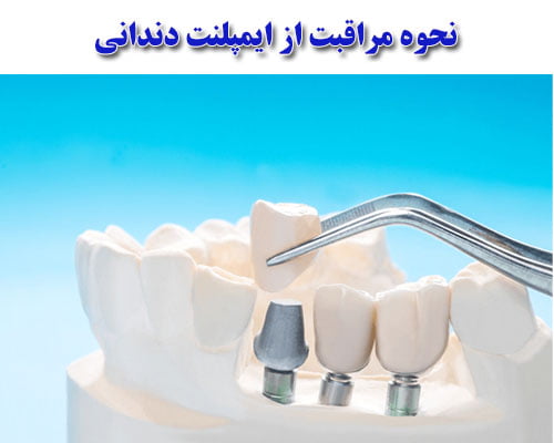 بهترین روش مراقبت ا از ایمپلنت