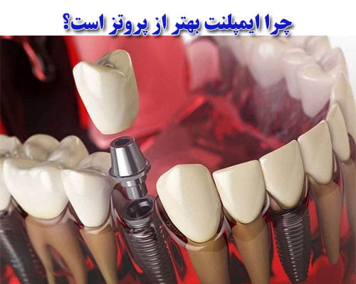 تفاوت ایمپلنت با پروتز متحرک