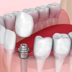 ایمپلنت کره ای و ویژگی های آن