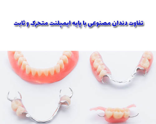 دندان مصنوعی با پایه ایمپلنت متحرک؛ این روش، معمولاً در مواردی که تعداد ایمپلنت‌ها کم و مناسب برای پشتیبانی دندان‌های ثابت نیست، استفاده می‌شود. 