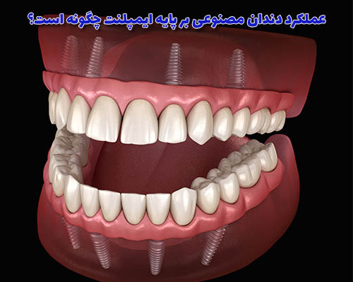 ایمپلنت‌ها به عنوان پایه‌های زیرساختی عمل می‌کنند و دندان مصنوعی را به طور دائمی در مکان خود نگه می‌دارند.