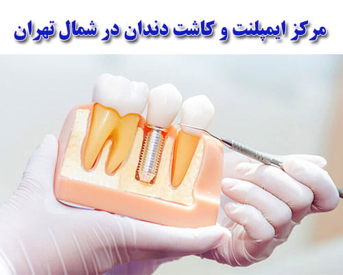 بهترین مرکز ایمپلنت شمال تهران