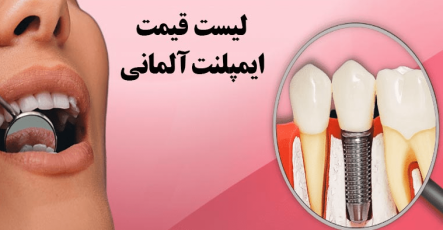 قیمت ایمپلنت آلمانی در سال ۱۴۰۵ + راهنمای کامل خرید و هزینه