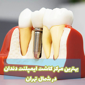 ایمپلنت دندان شمال تهران