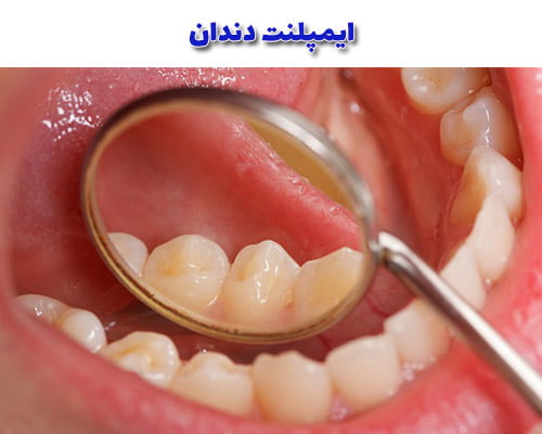ایمپلنت دندان