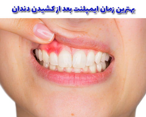 بهترین زمان ایمپلنت بعد از کشیدن دندان