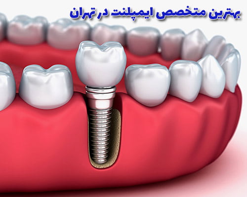 بهترین متخصص ایمپلنت در تهران