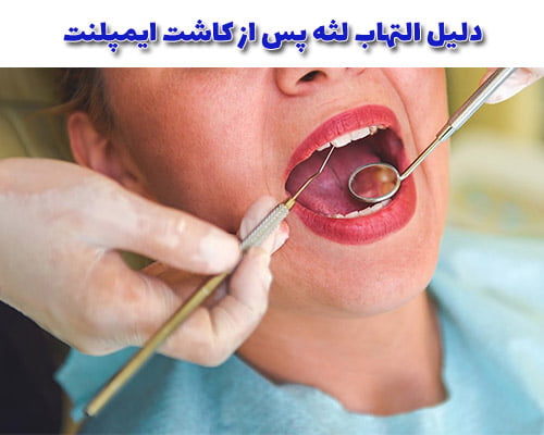 دلیل التهاب لثه پس از کاشت ایمپلنت