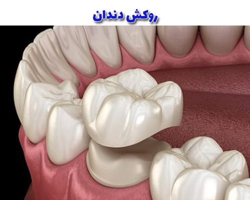 روکش دندان