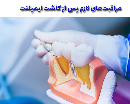 مراقبتهای لازم پس از کاشت ایمپلنت